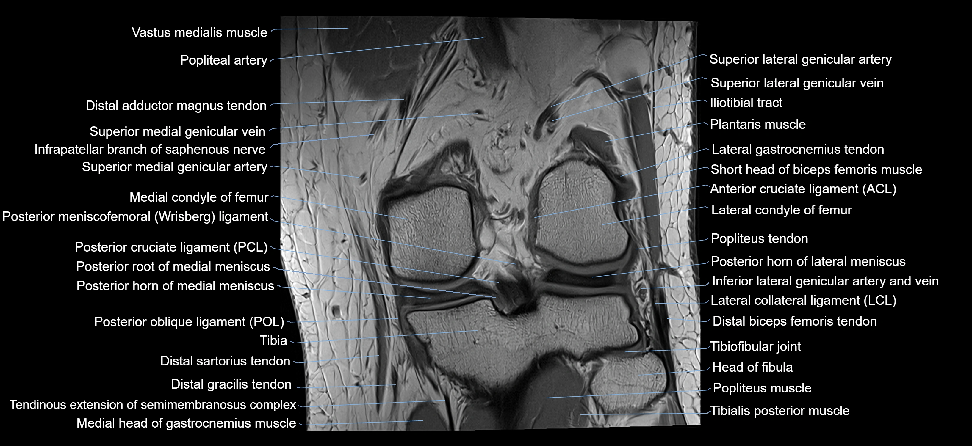 MRI knee coronal cross sectional anatomy labelled 3T radiology  image-04001-00026.webp